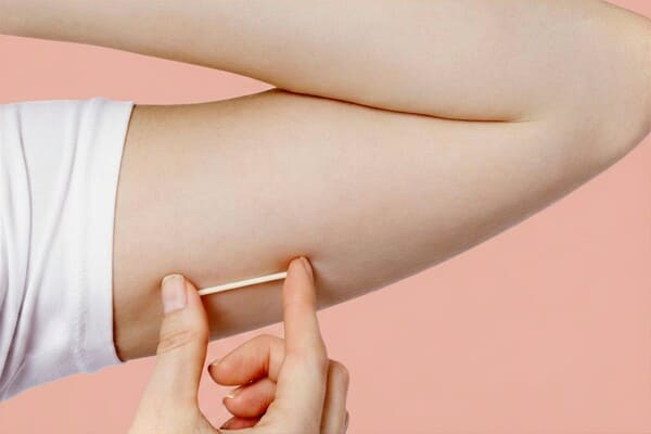 Foto - Implante Hormonal (Implanon)